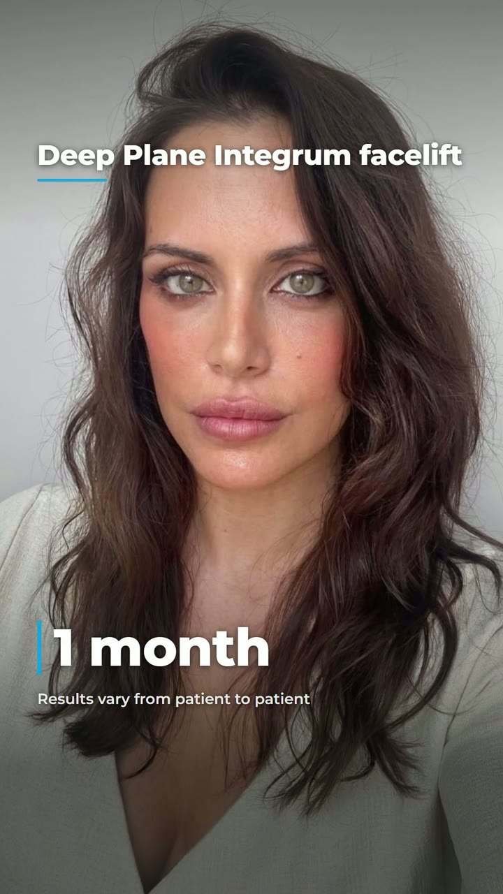 Facelift patient progress: before, 3 weeks and 1 month